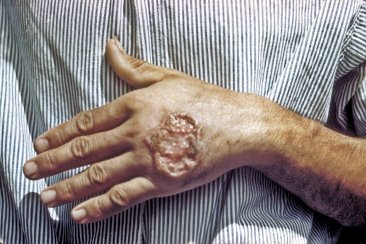 En Concordia, la zoonosis no atacó a pacientes humanos. En Concordia, la zoonosis no atacó a pacientes humanos.