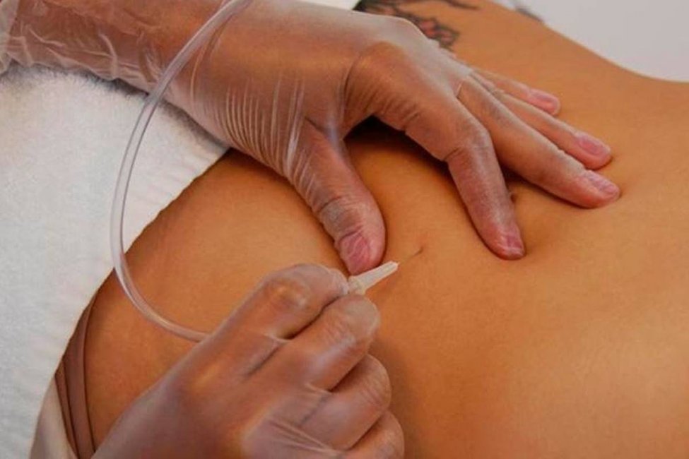 El Ministerio de Salud investiga "de oficio" el presunto caso de mala praxis