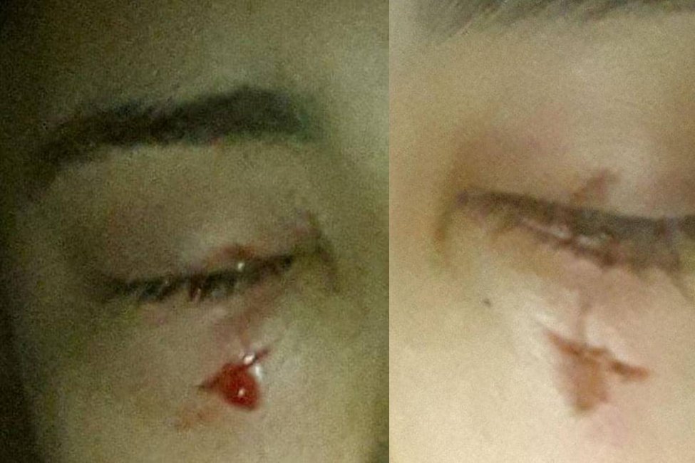 Una joven concordiense recibió un piedrazo en el ojo y ahora enfrenta una compleja cirugía