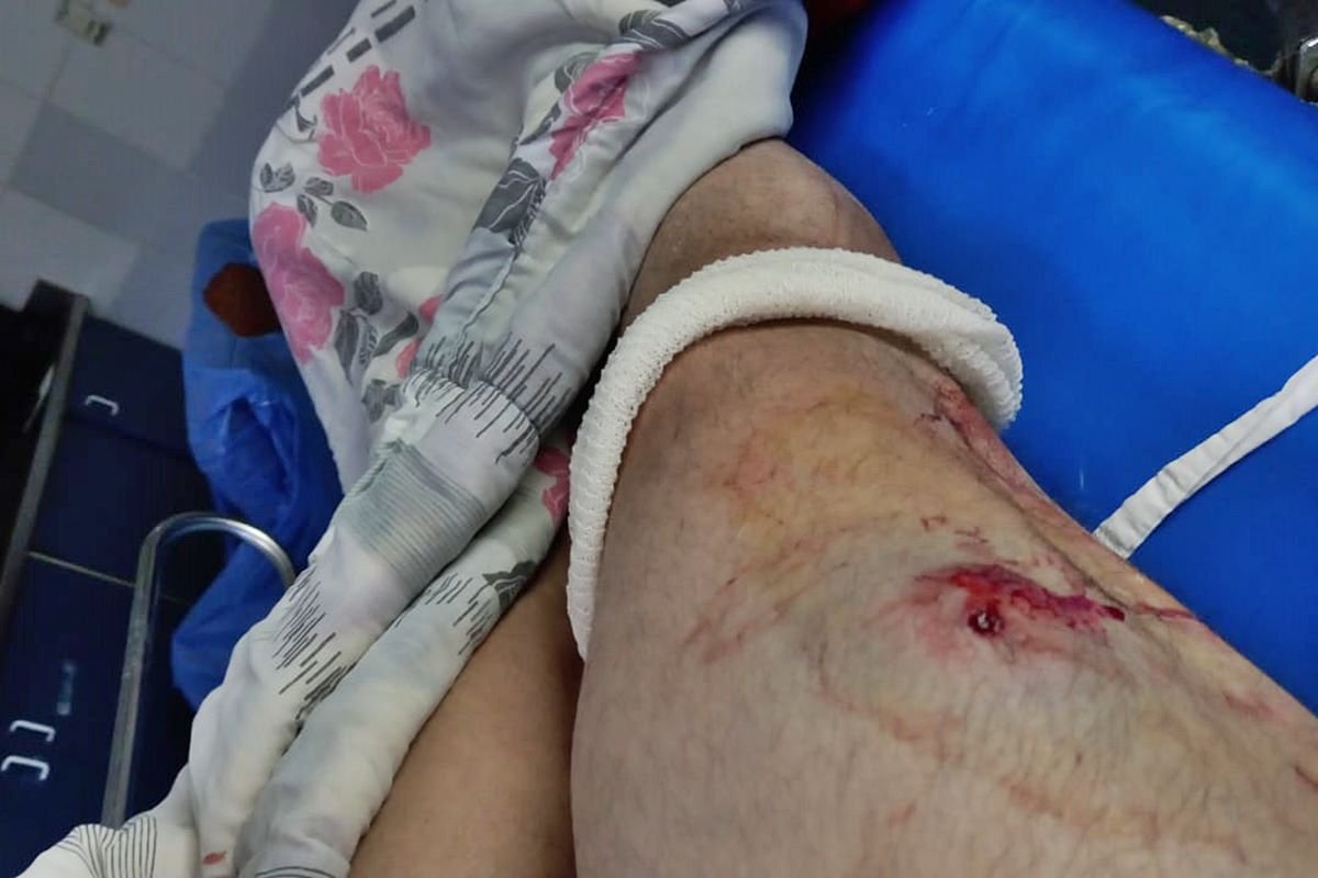 La bala le impacto en su pierna derecha