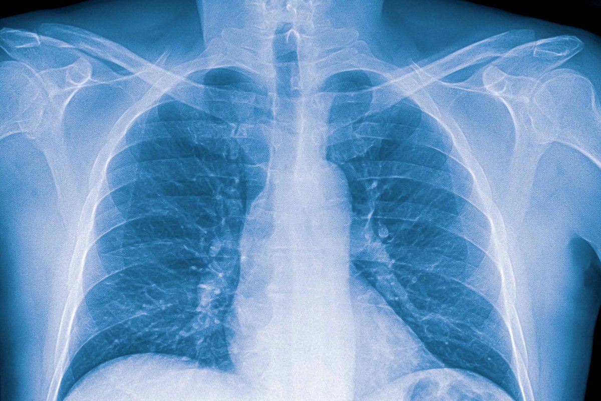 El D&iacute;a Mundial de la Neumon&iacute;a se celebra desde el 12 de noviembre de 2009.