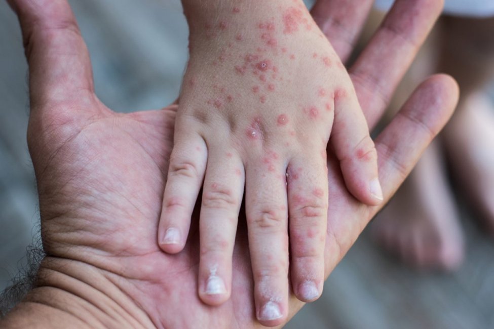 El Ministerio de Salud emitió una alerta epidemiológica por sarampión para una localidad de la región