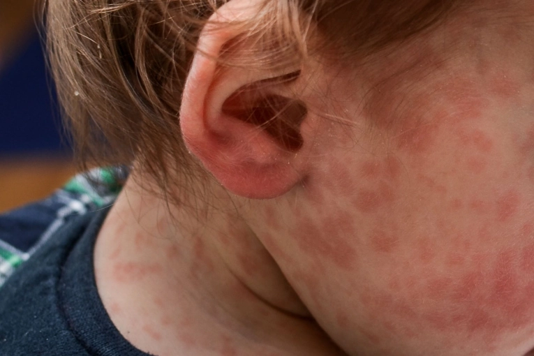 Se confirmó un caso de sarampión en la provincia de Entre Ríos