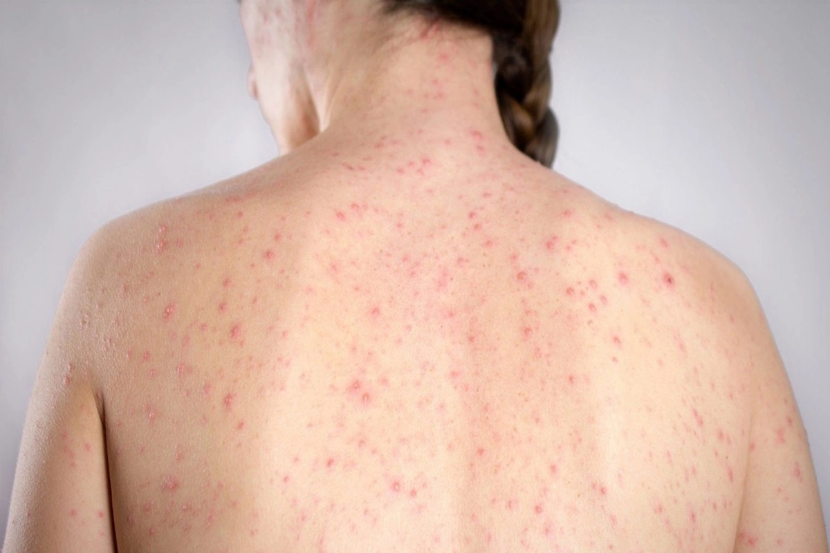 Las muestras fueron enviadas al Instituto Nacional de Enfermedades Infecciosas.