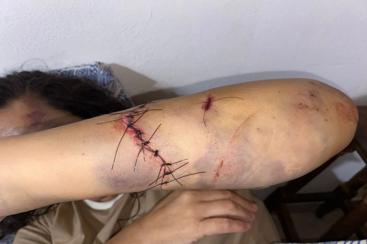 La v&iacute;ctima ampliar&aacute; su denuncia en las pr&oacute;ximas horas, debido a la gravedad de las lesiones.