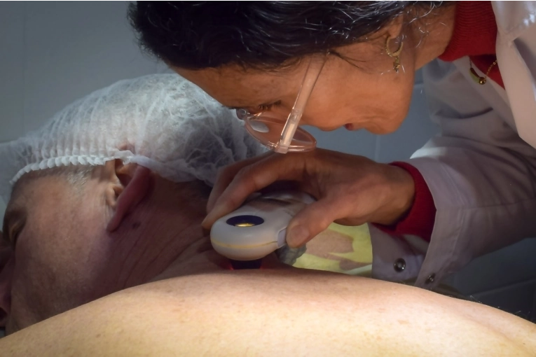 Salud impulsa la detección temprana del cáncer de piel mediante controles preventivos