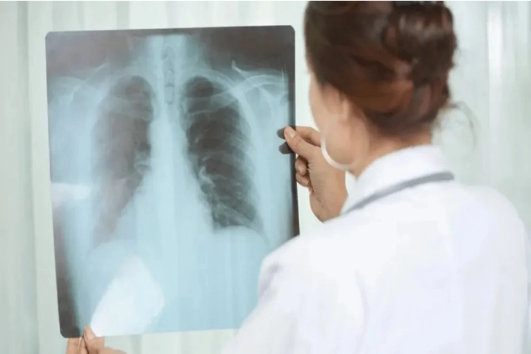 Los casos de tuberculosis aumentaron en Entre Ríos casi un 39% en lo que va de 2026